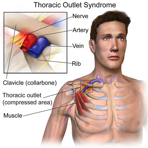 cervical compression test thoracic outlet syndrome|thoracic outlet syndrome electromyography.